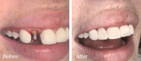 Dental Crowns - Before and After